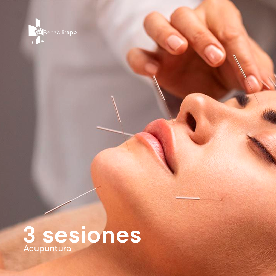 3 SESIONES DE ACUPUNTURA